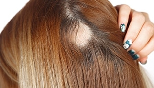 Kreisrunder Haarausfall: Wie gehe ich damit um? Kreisrunder Haarausfall: Wie gehe ich damit um?